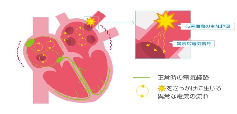 心房細動