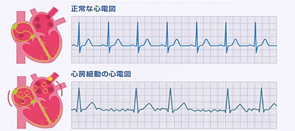 高齢者における心房細動の症状