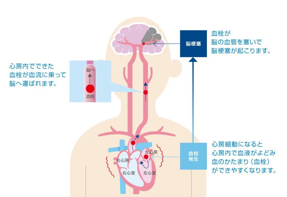 心房細動